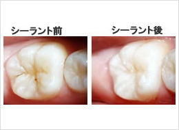 小児歯科 シーラント