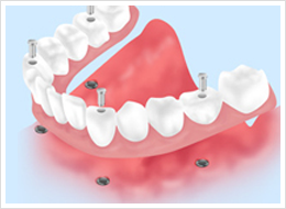 インプラントデンチャー